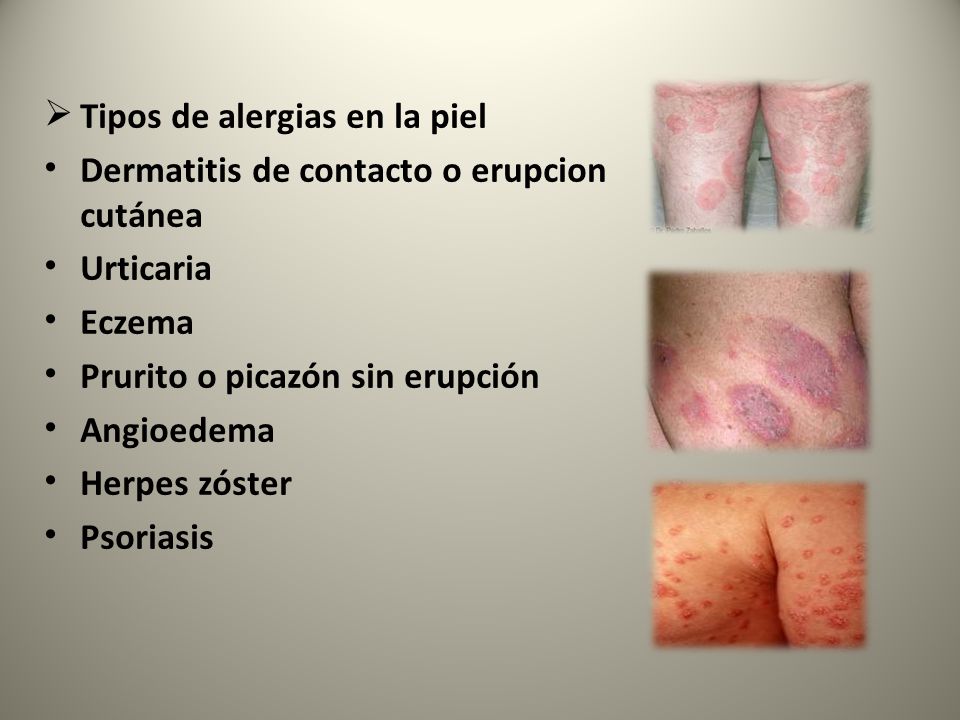 Que no es necesario hacer a la psoriasis